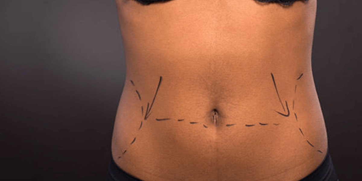 Achieve a Flatter Abdomen: Tummy Tuck with Dr. Kentse Moeketsi - Dr ...