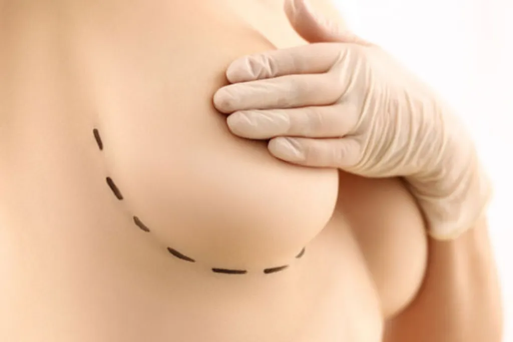 Breast Reconstruction