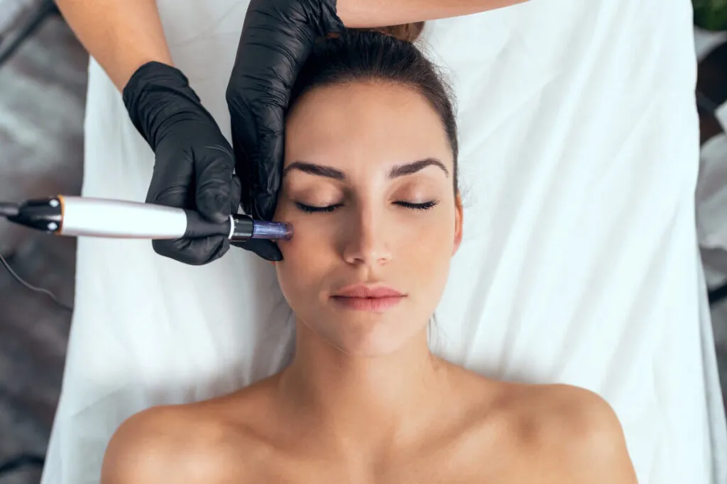 Microneedling procedure